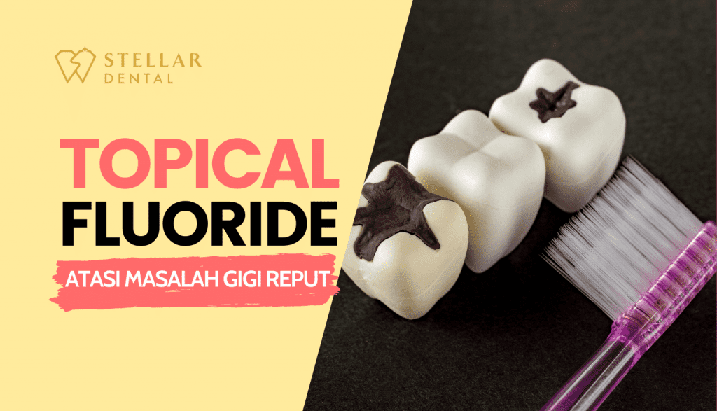 topical fluoride