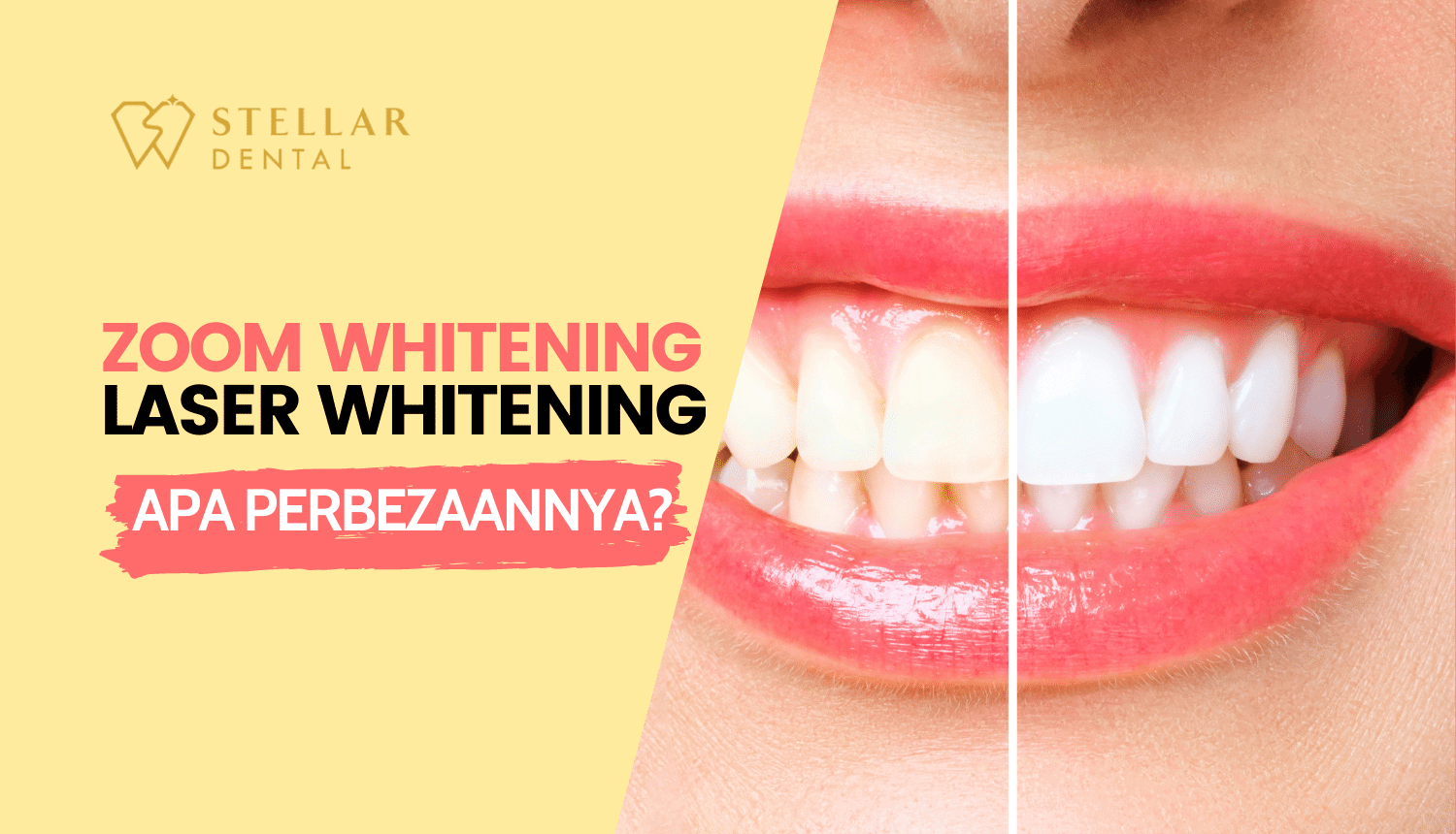 Zoom Whitening