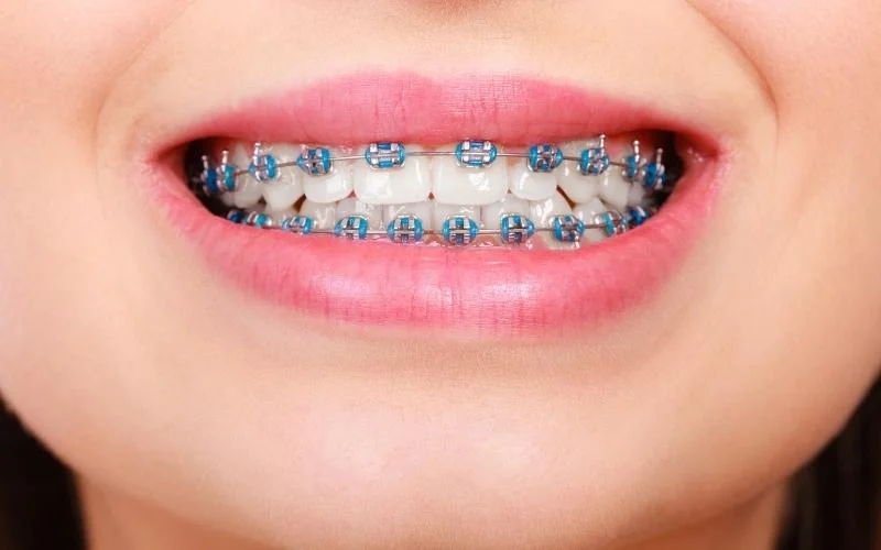 conventional braces price procedure cover photo