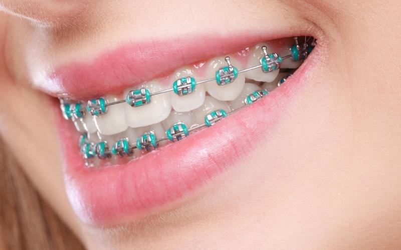 3 Types Of Braces And Costs For Each One Stellar Dental