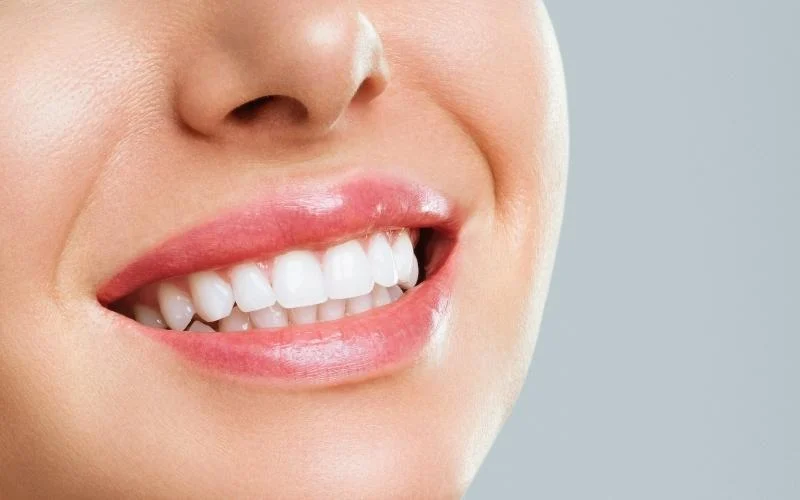teeth veneers