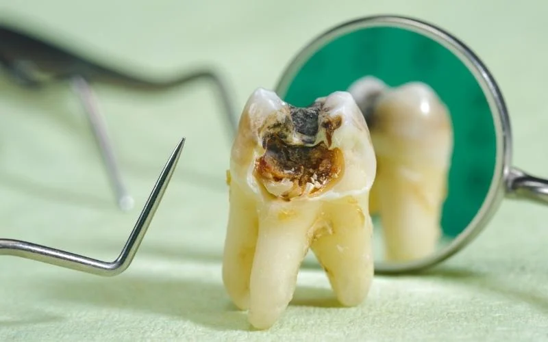 tooth extraction for tooth decay