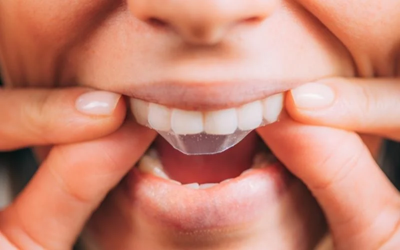 types of teeth whitening