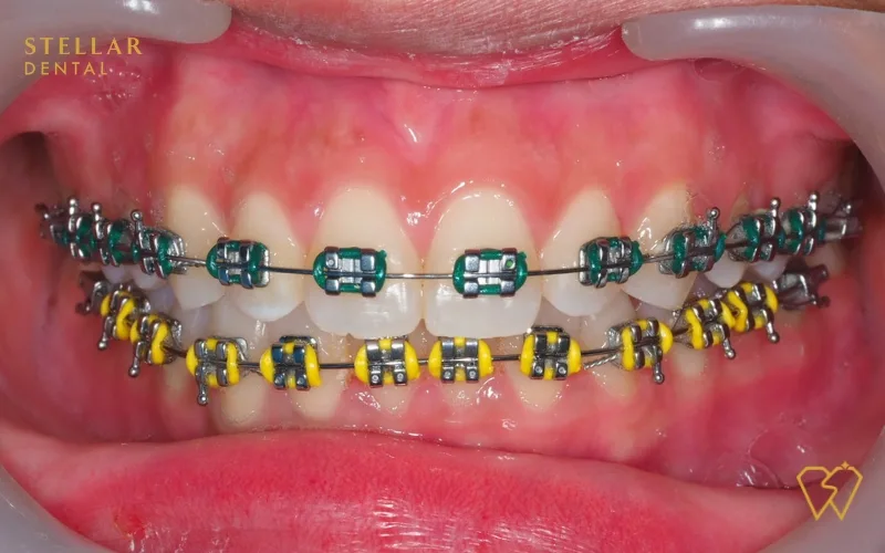 Braces Colors Top Picks For 2023 Stellar Dental
