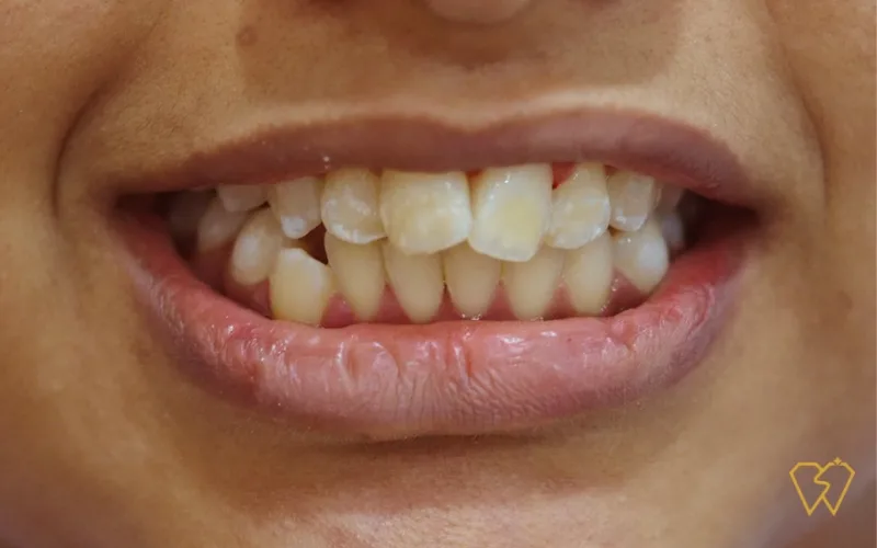 white spots on teeth
