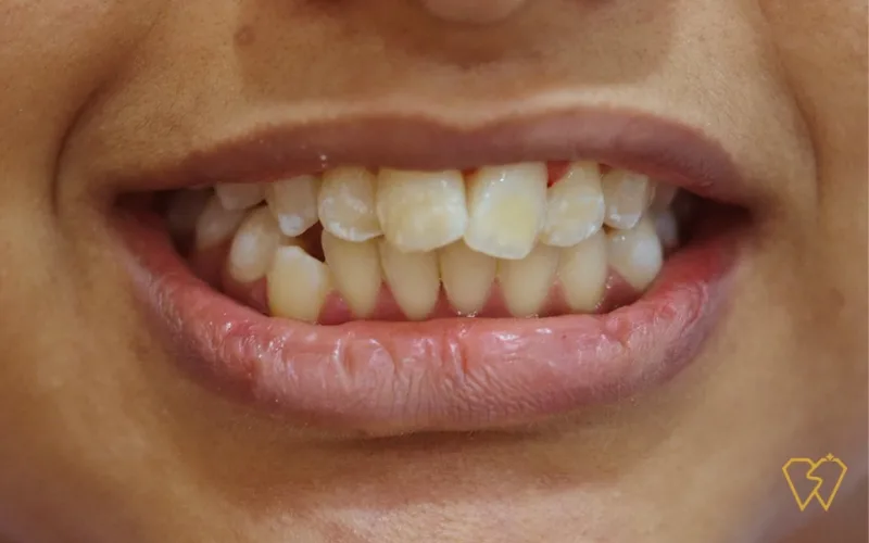 What are white spots on teeth and what can you do about them