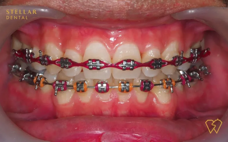 Orange braces deals