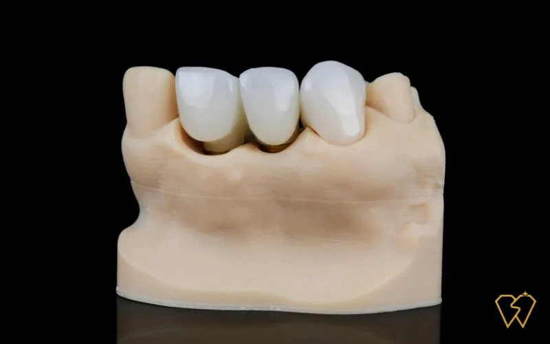 dental bridge