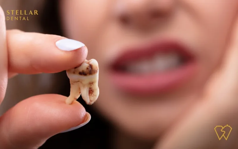 tooth decay