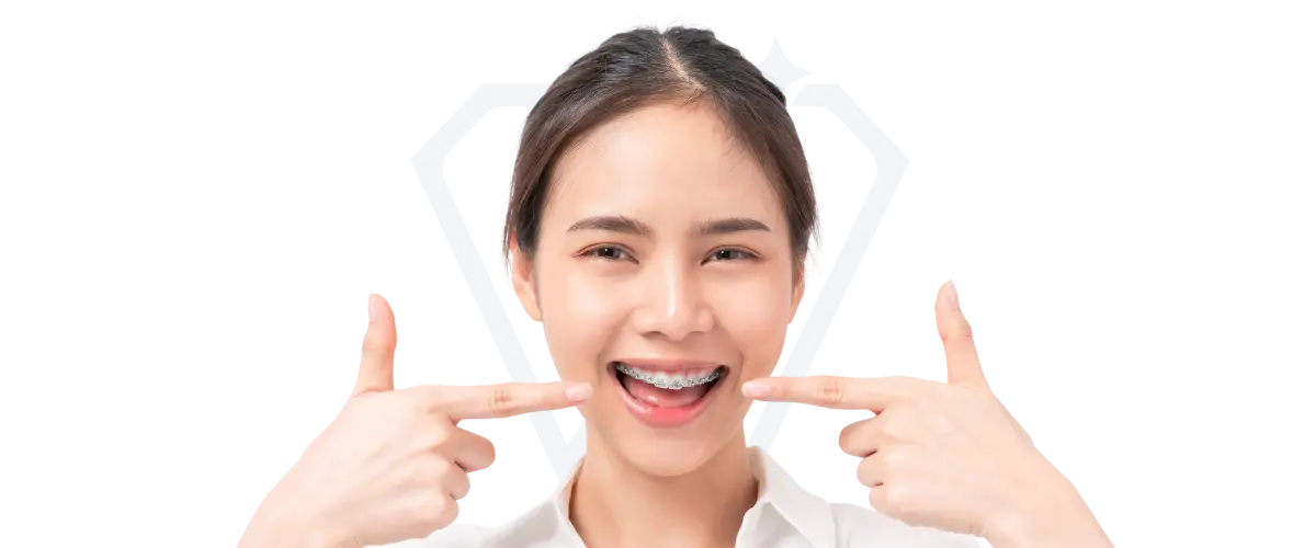 1 Braces Kota Damansara Stellar Dental