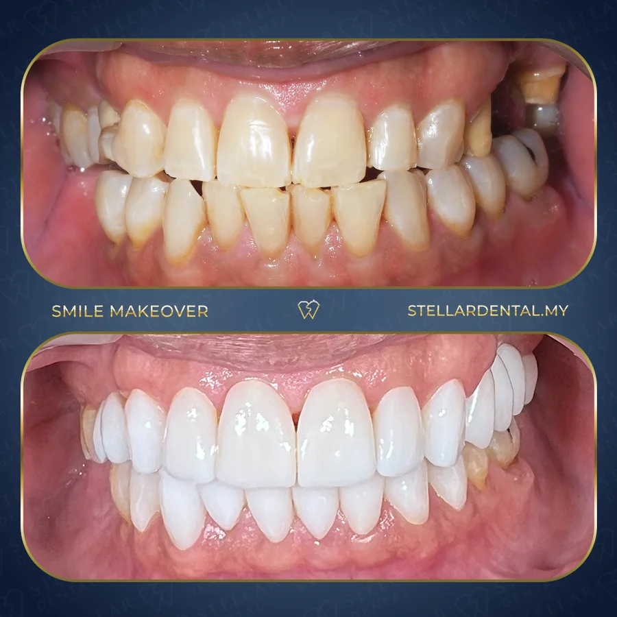 Before and after smile makeover at Stellar Dental