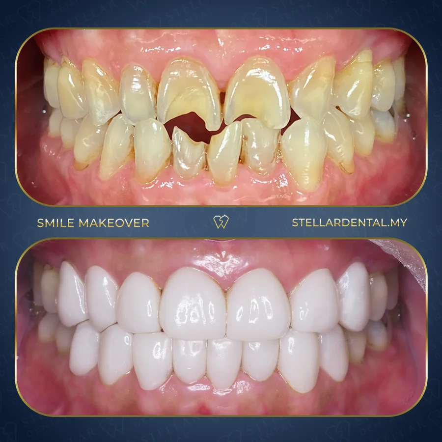 Before and after dental treatment at Stellar Dental